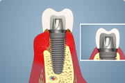 Crown Emergence Profile Buccal and Lingual Incorrect